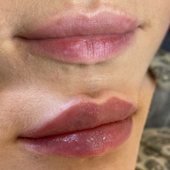 Збільшення губ
                    Косметолог-инъекционист Татьяна Ирпень