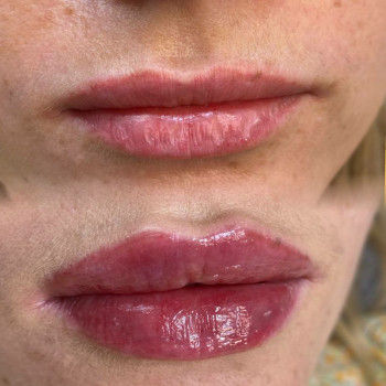 Збільшення губ
                    Косметолог-инъекционист Татьяна Ирпень