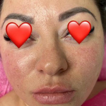 PRX-T33 пілінг
                    Салон краси Atmosfera Krasu Чернівці