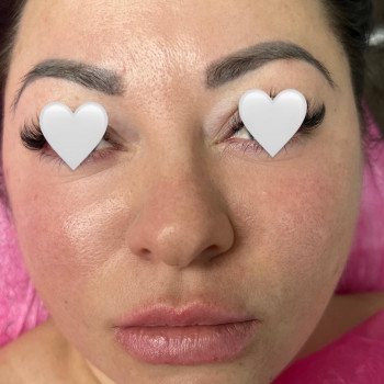 PRX-T33 пілінг
                    Салон краси Atmosfera Krasu Чернівці