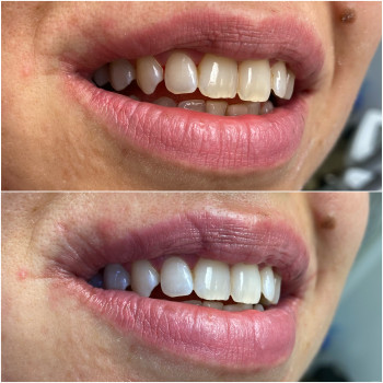 Відбілювання Зубів Magic Smile
                    Стоматолог Юлия Київ