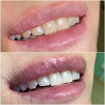 Відбілювання Зубів Magic Smile
                    Стоматолог Юлия Київ