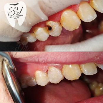 Лікування карієсу
                    Стоматолог Юлия Київ