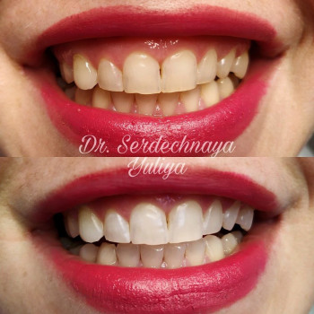 Відбілювання зубів Magic Smile