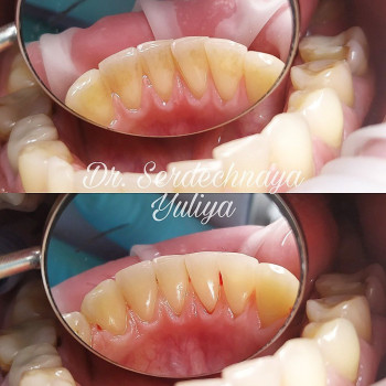 Професійна чистка зубів