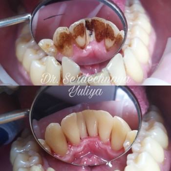 Професійна чистка зубів