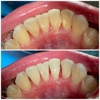 Професійна чистка зубів