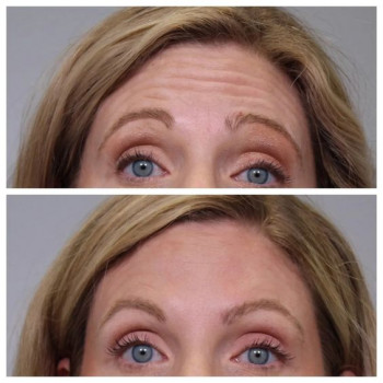 Ботулінотерапія: інноваційний підхід до омолодження та корекції рис обличчя
                    Студия лазерной эпиляции Центр лазерної косметології Луцк