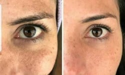 Біоревіталізація обличчя: глибоке зволоження та омолодження шкіри Студія лазерної епіляції Центр лазерної косметології Луцьк