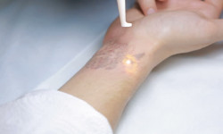 Видалення татуювання тіла чорного кольору до 20 см кв Тату салон 1000 itattoo Киев