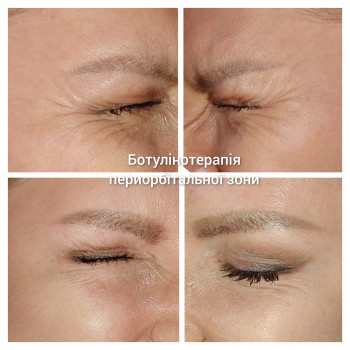Ботулинотерапия
                    Косметолог Татьяна Каменское