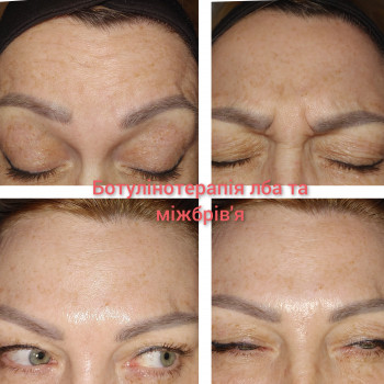 Ботулинотерапия
                    Косметолог Татьяна Каменское