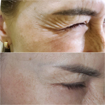 Ботулинотерапия
                    Косметолог Татьяна Каменское