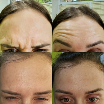 Ботулинотерапия
                    Косметолог Татьяна Каменское