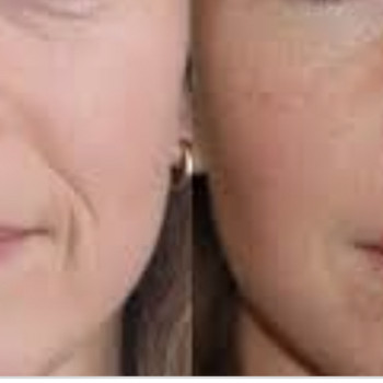 Фонофорез, аппаратная процедура для лица
                    Косметолог Елена Одесса