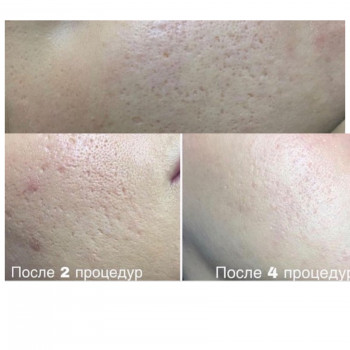 Фонофорез, аппаратная процедура для лица
                    Косметолог Елена Одесса