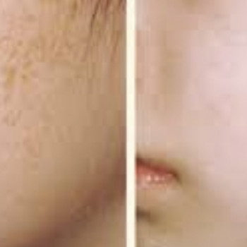 Микродермабразия или алмазный пилинг
                    Косметолог Елена Одесса