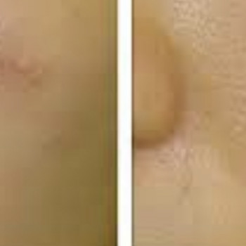 Микродермабразия или алмазный пилинг
                    Косметолог Елена Одесса