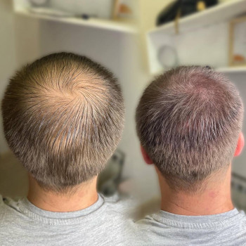 Трихопігментація
                    Мастер перманентного макияжа Ольга Днепр