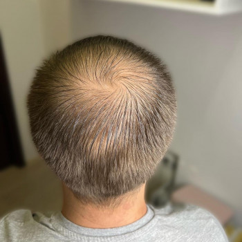 Трихопігментація
                    Мастер перманентного макияжа Ольга Днепр