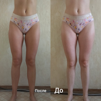 Антицеллюлитный массаж