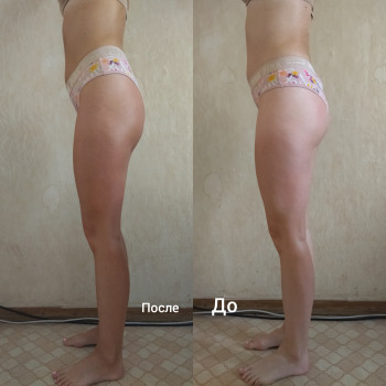 Антицеллюлитный массаж