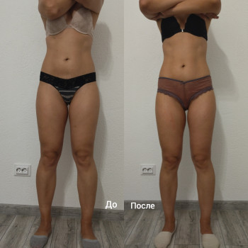 Антицеллюлитный массаж