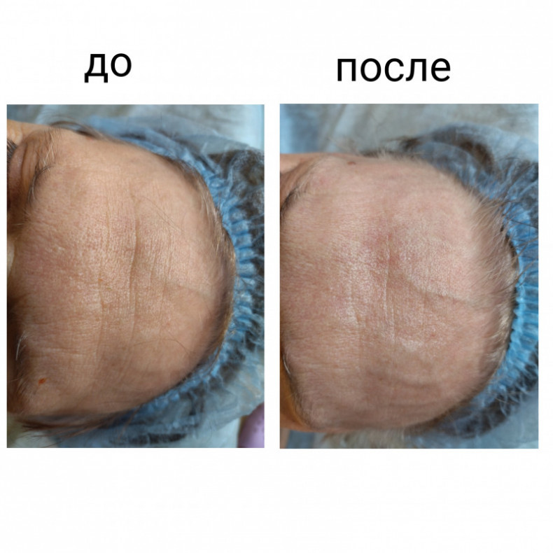 Скульптурирующий массаж лица, шеи и декольте, фото - Масажист Анна Юрьєва