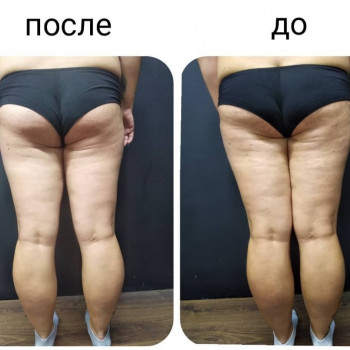 Антицеллюлитный массаж