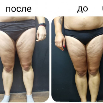 Антицеллюлитный массаж