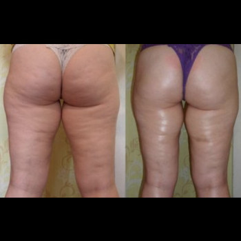 Обертывания/Пеленания для похудения
                    Косметолог Елена Одеса