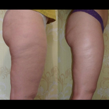 Обертывания/Пеленания для похудения
                    Косметолог Елена Одеса