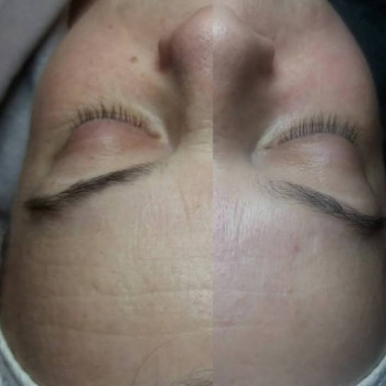 Мікродембразія