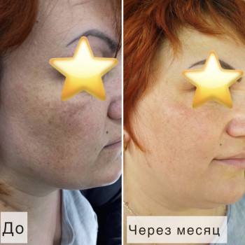 Лечение пигментации