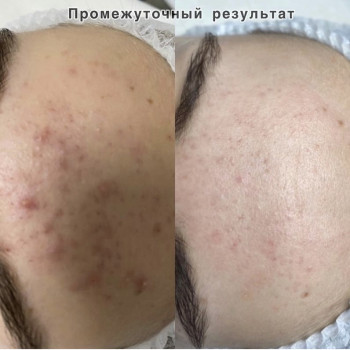 Лечение акне