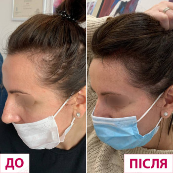 уколы ботокса для лица, коррекция морщин