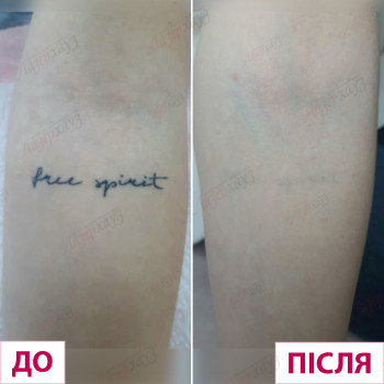 удаление тату
