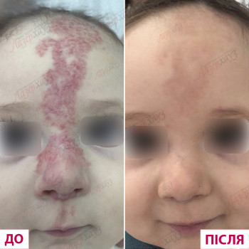 уколы ботокса для лица, коррекция морщин