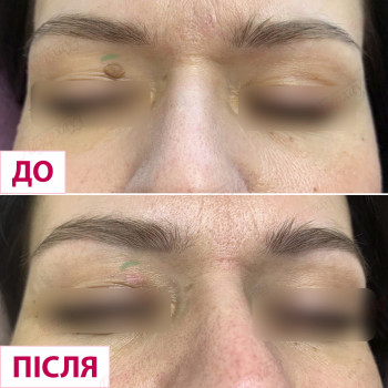 видалення татуажу, татуаж брів