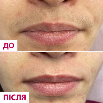 татуаж бровей, лазерная эпиляция
