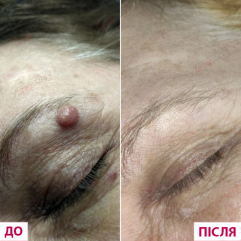 уколы ботокса для лица