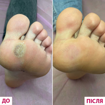 лікування стопи, мозоль на стопі