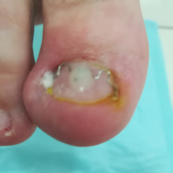 Лiкування врослого та деформованого нiгтя
                    Подолог Наталья Запорожье