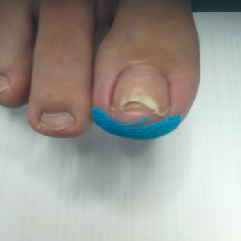 Лiкування врослого та деформованого нiгтя
                    Подолог Наталья Запорожье