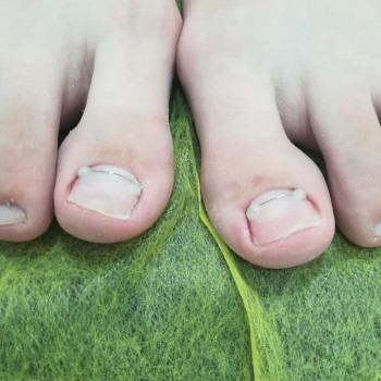 Титановая нить 4 мiсяцi пicля початку лiкування деформирмацi