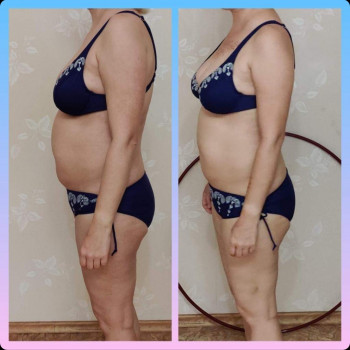 Антицеллюлитный массаж