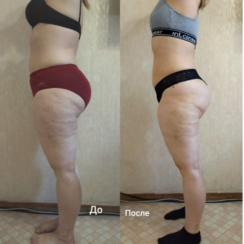 Антицеллюлитный массаж