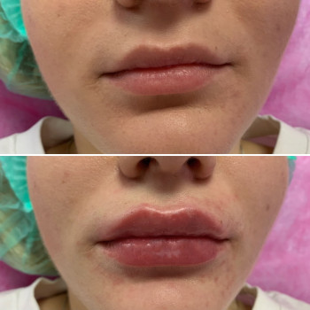 Збільшення губ