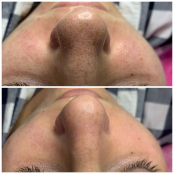 Чистка обличчя