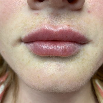 Збільшення губ